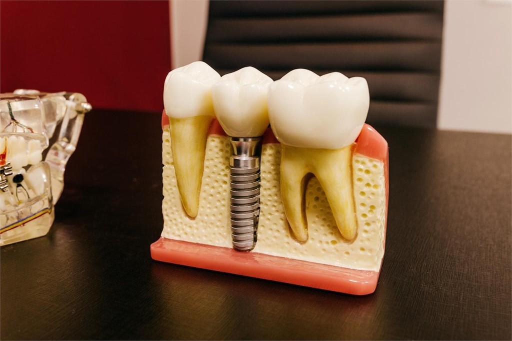 Ventajas de los implantes dentales