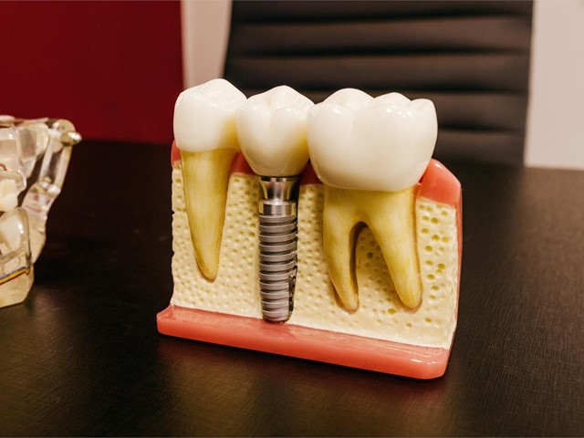 Ventajas de los implantes dentales